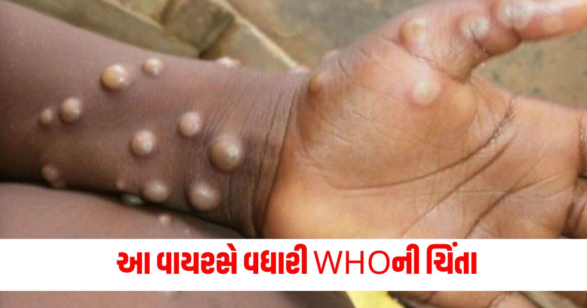 monkeypox virus has raised who concern emergency meeting calls it may be declared