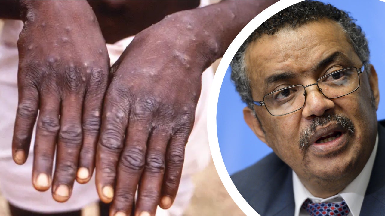 monkeypox virus has raised who concern emergency meeting calls it may be declared