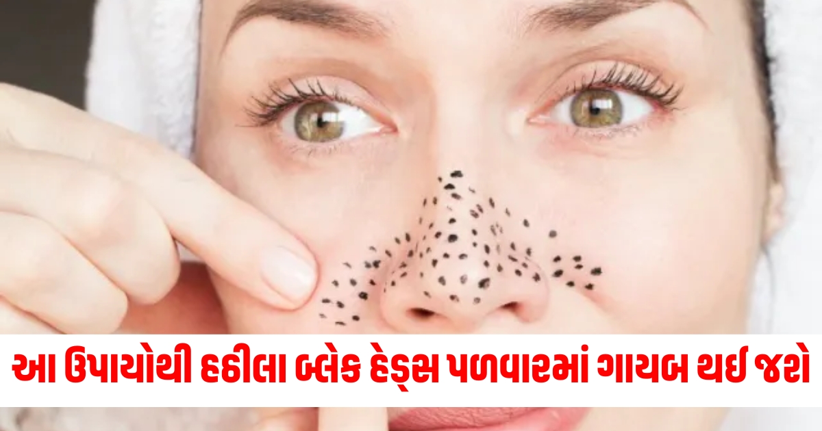 fashion beauty these remedies will make black heads disappear in a jiffy there will be no pain at all