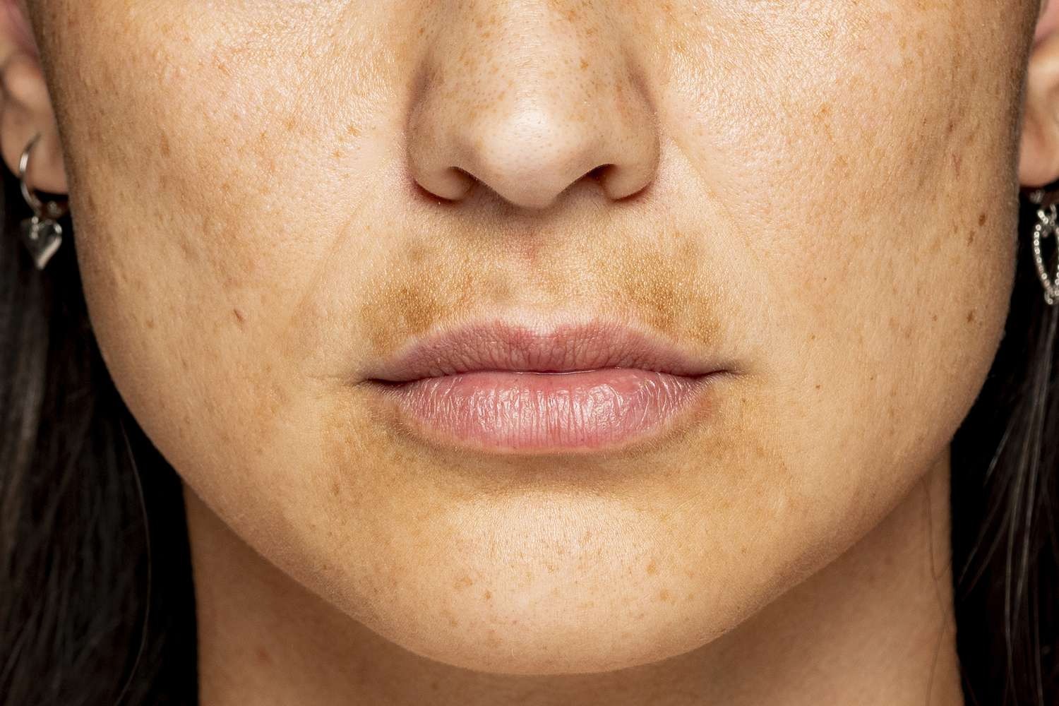 follow this easy home remedy to remove tanning and blackness around the lips