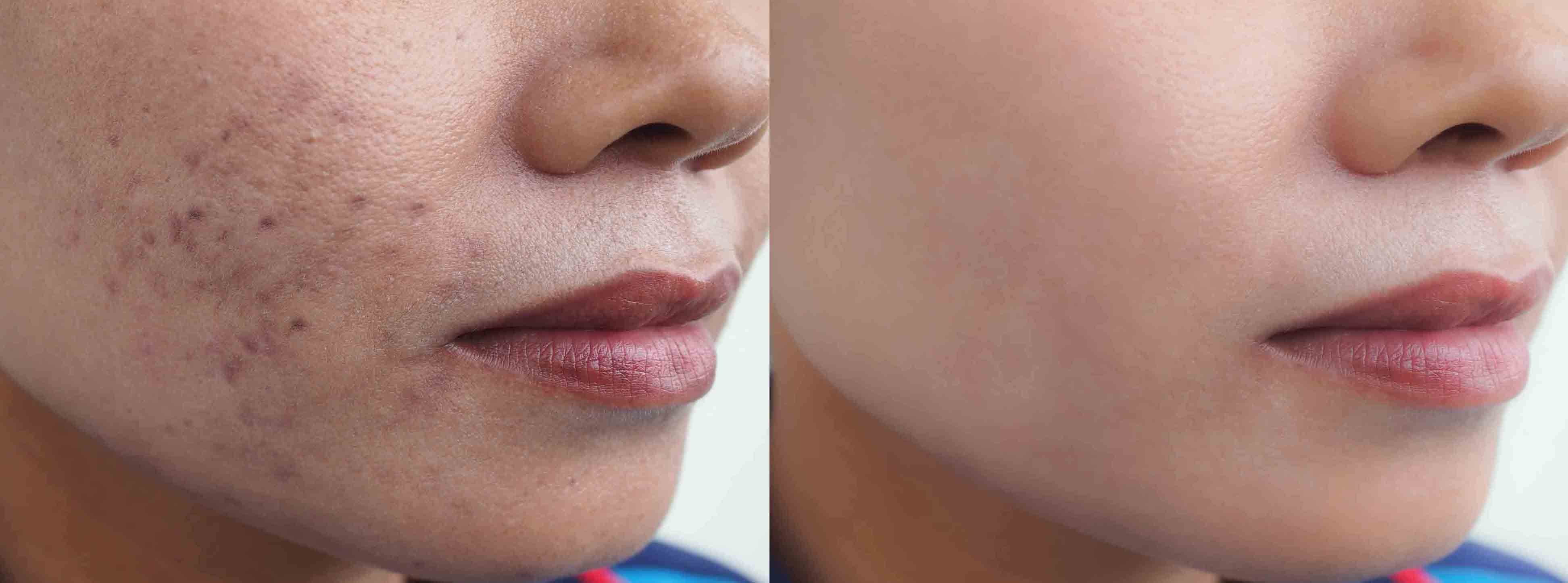 follow this easy home remedy to remove tanning and blackness around the lips1