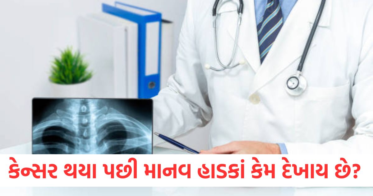 why do human bones become visible after getting cancer read full article