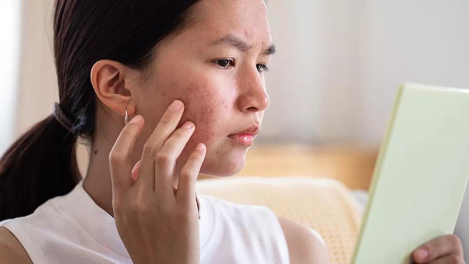 pimple cure tips use these things on a daily basis to get rid of pimples and acne