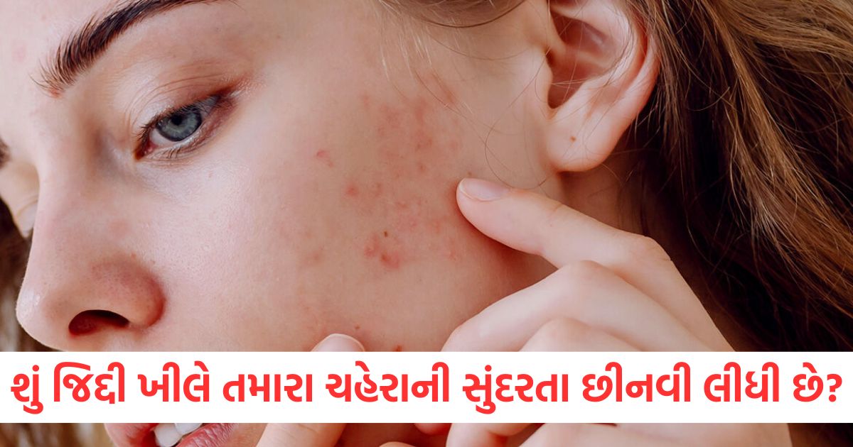 pimple cure tips use these things on a daily basis to get rid of pimples and acne2