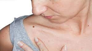 samudrik shastra meaning of moles on body parts which moles are unlucky1