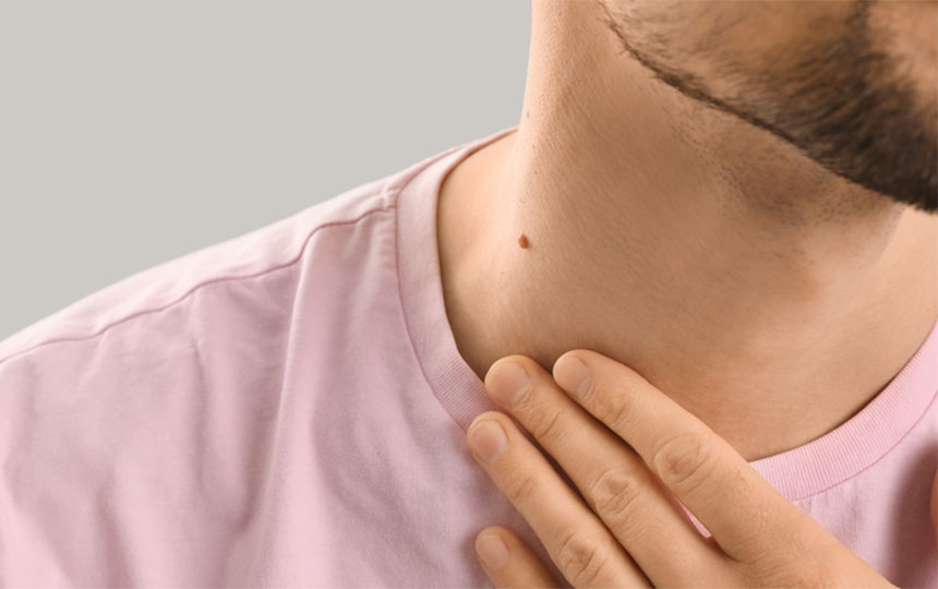 samudrik shastra meaning of moles on body parts which moles are unlucky2