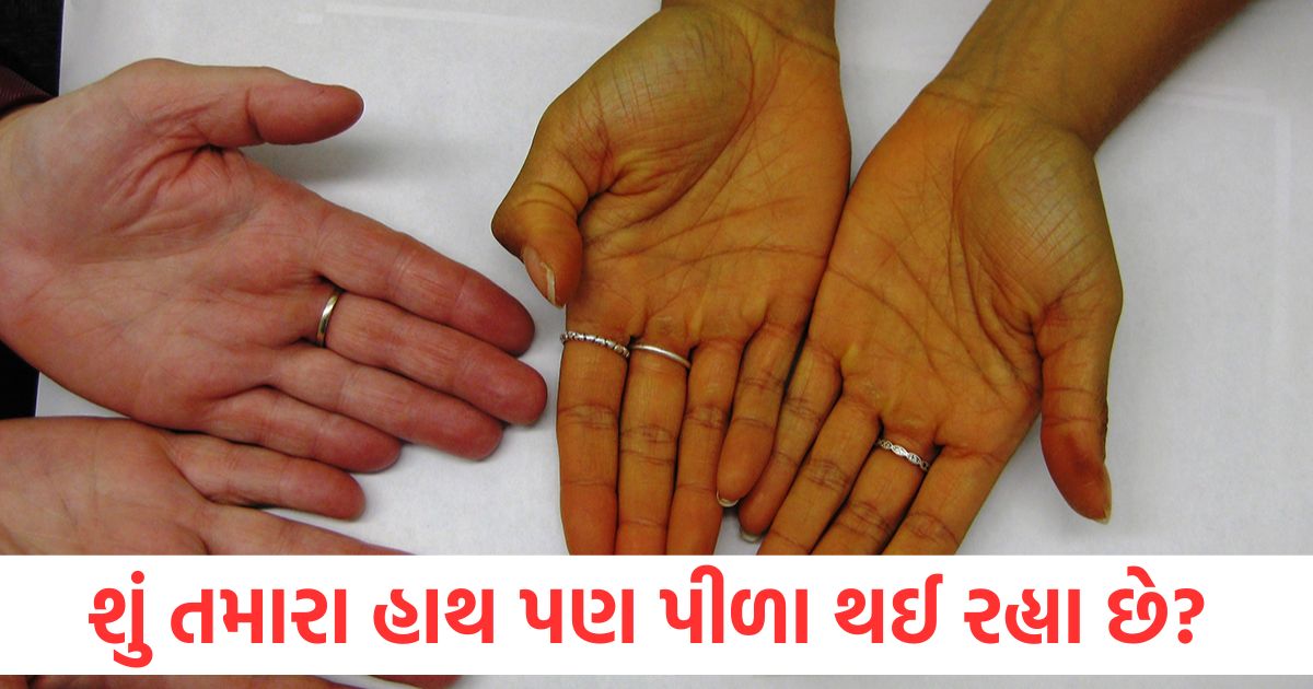 yellow hands palms signs of dangerous disease know reasons
