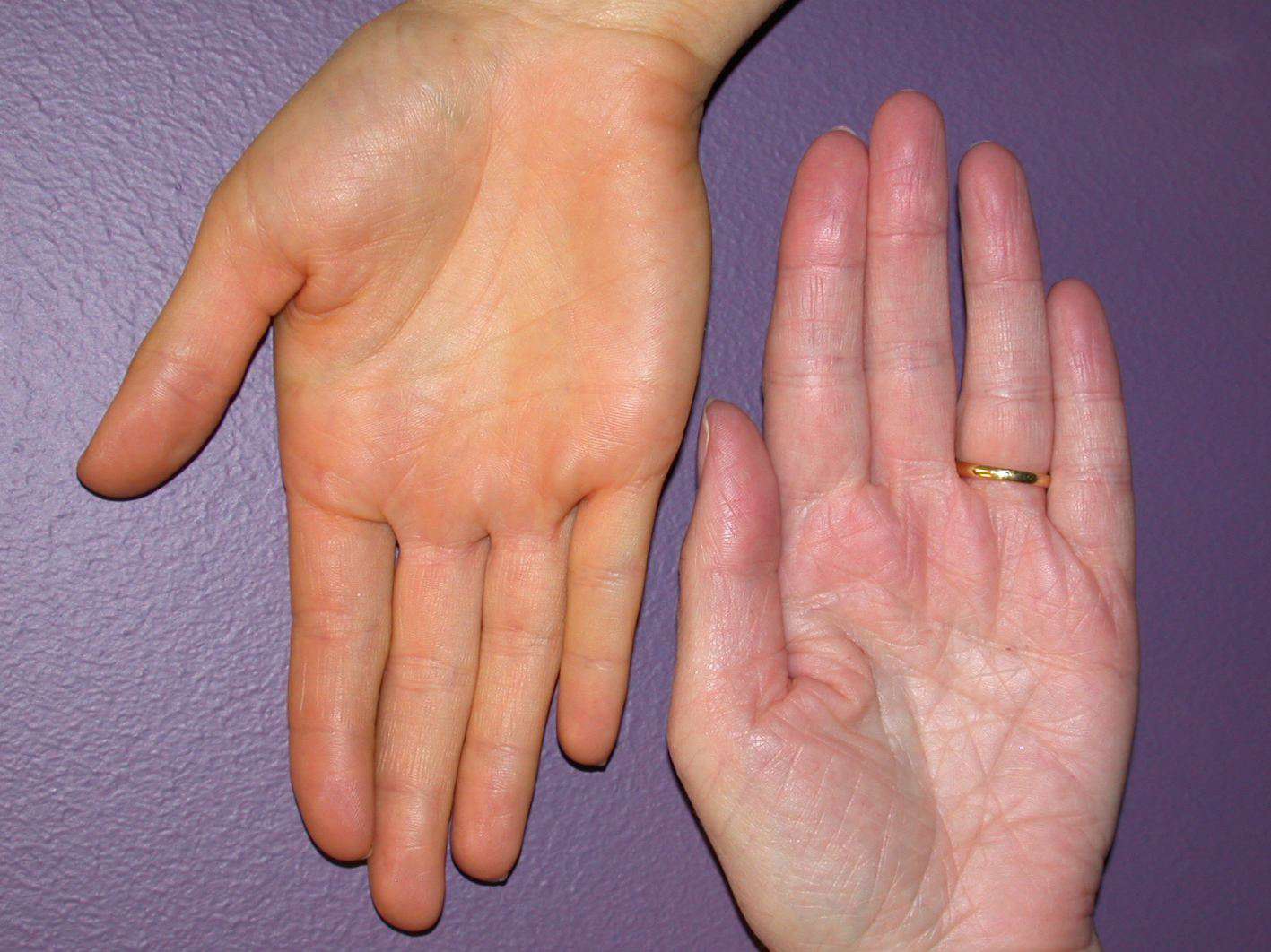 yellow hands palms signs of dangerous disease know reasons1