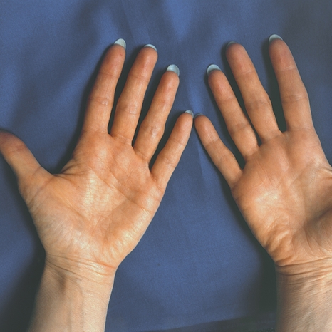 yellow hands palms signs of dangerous disease know reasons2