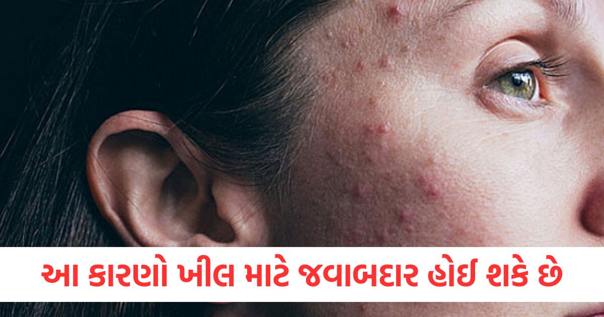આ કારણો ખીલ માટે જવાબદાર હોઈ શકે છેere