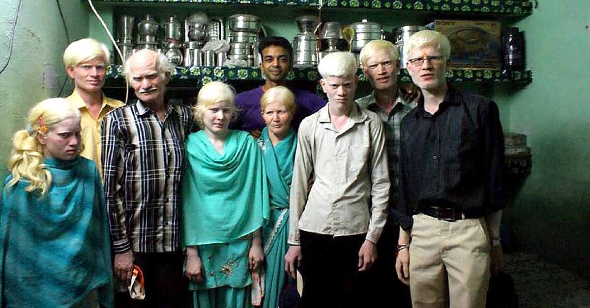 bihar gopalganj family suffers from genetic disease albinism people call britishers1